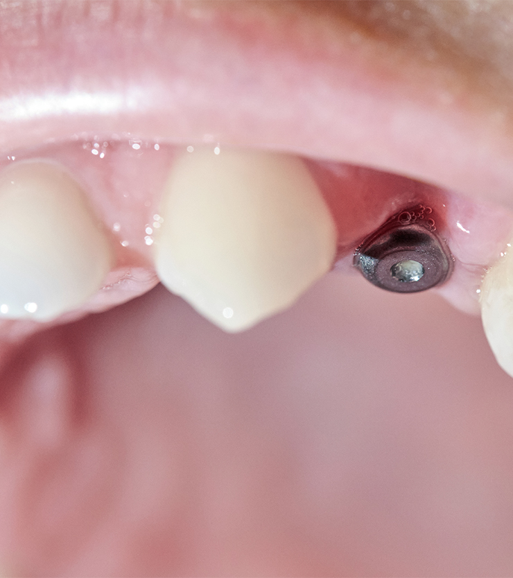 Implantes rápidos
